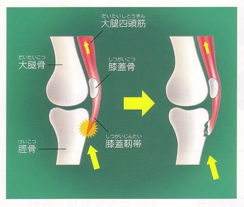 子供のスポーツ障害　①オスグット