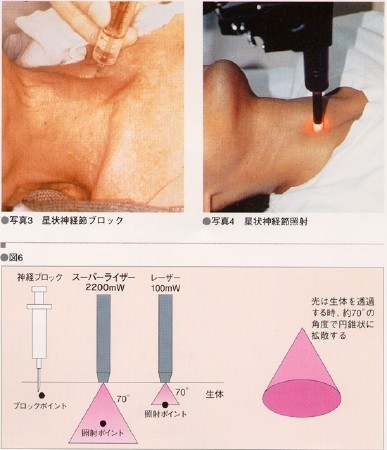 長引く辛いムチうち症の治療について