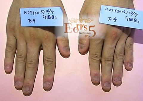 オニコファジー(噛爪症)のお爪の育成、K藤様の場合 ~初めてお直し~