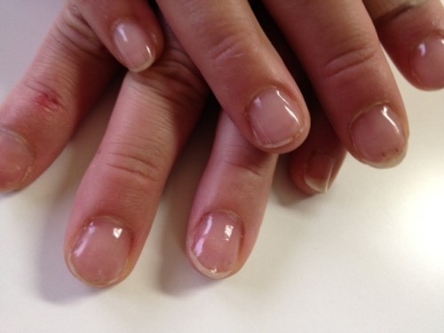 人工爪での補強。